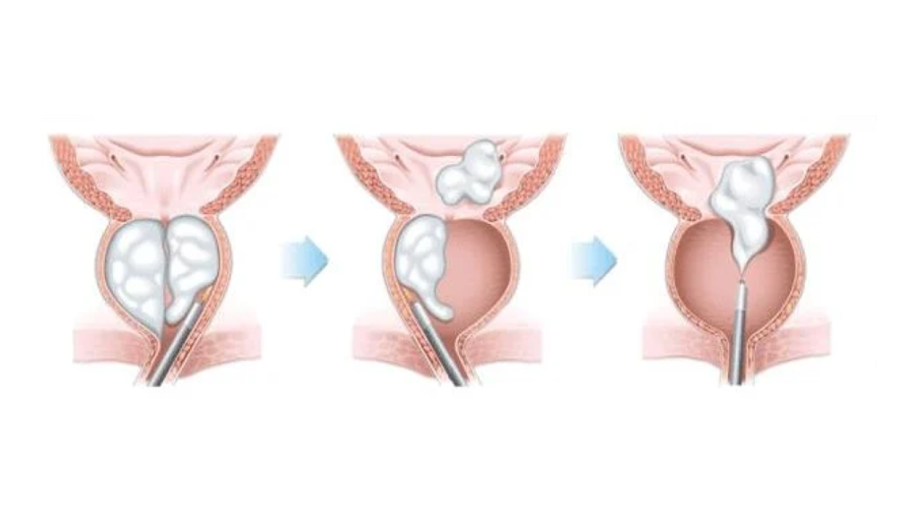 Cirurgia da próstata, para falar sobre como funciona o HoLEP