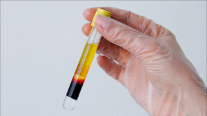 Mão segurando um tubo com Sangue na urina.